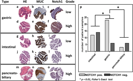 Notch1 Expression In Human Ipmn Representative Micropho Open I