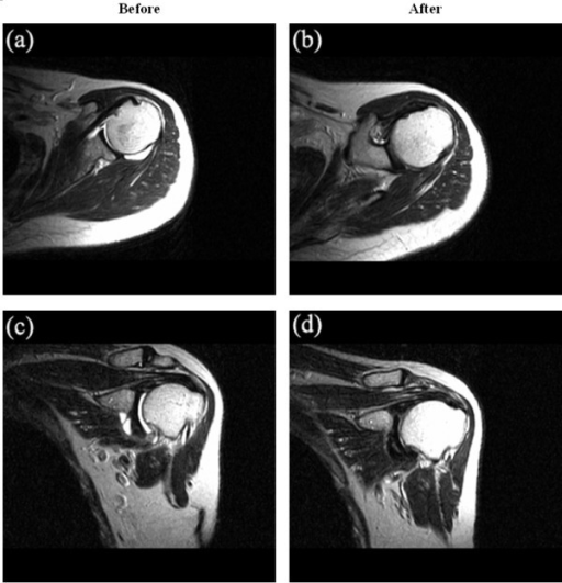 Magnetic resonance images (MRI) of a patient before and | Open-i