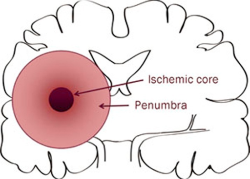 Ischemic core and penumbra after stroke. While neurons | Open-i