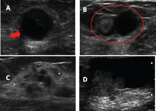 Ultrasound images described in breast papillary lesions | Open-i