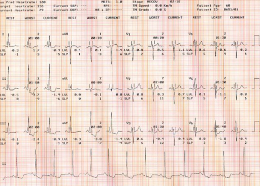 summary-of-a-positive-exercise-stress-test-in-one-patie-open-i