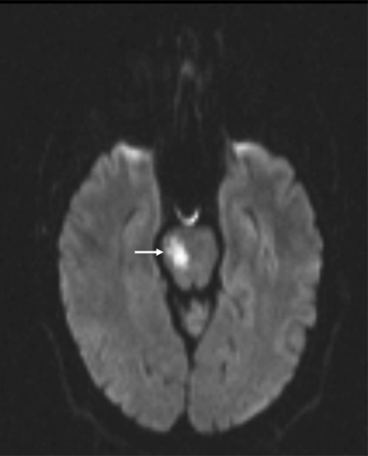 Image result for right pontine stroke dwi