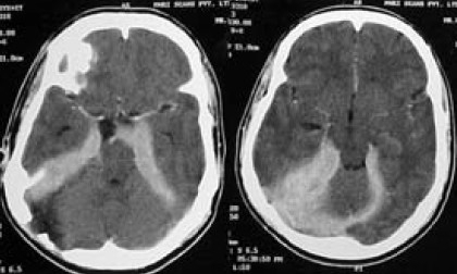 Post Operative CT Scan Of The Brain Plain And Contrast | Open-i