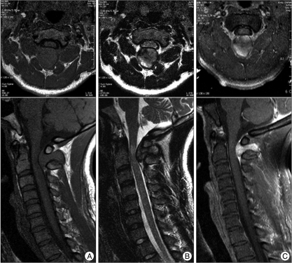 Preoperative MRI showing abnormal signal intensities on | Open-i