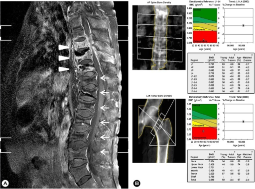 (A) Sagittal fat-suppressed contrast-enhanced T2 weighted MRI of the spine shows spondylitis of T8, 9, 10 with left paraspinal and anterior subligamentous abscesses (arrow head) and compression fractures at T8 through L5. (B) Low bone mineral density at lumbar spine and left femur is demonstrated, indicating "osteoporosis". AP, anteroposterior; BMD, bone mineral density.