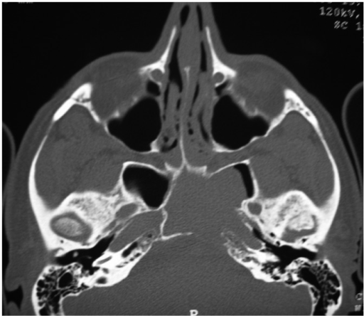 CT-scan without contrast of the same patient showing a | Open-i