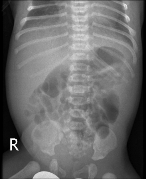 Zantac and stomach pain x ray