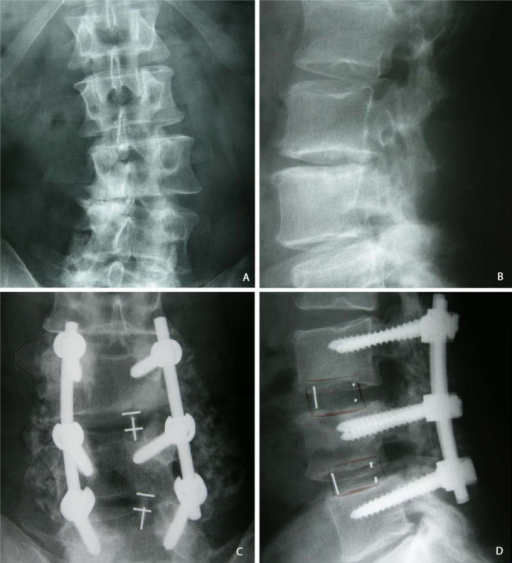 retrolisthesis of spine Physical examination identified laxity in his lower lumbar spine at he presented with x-rays from 2006 that showed a grade i retrolisthesis or movement of one. retrolisthesis of spine Physical examination identified laxity in his lower lumbar spine at he presented with x-rays from 2006 that showed a grade i retrolisthesis or movement of one.
