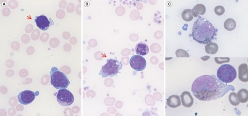 (A, B) Bone marrow aspirates showing megakaryoblasts wi | Open-i