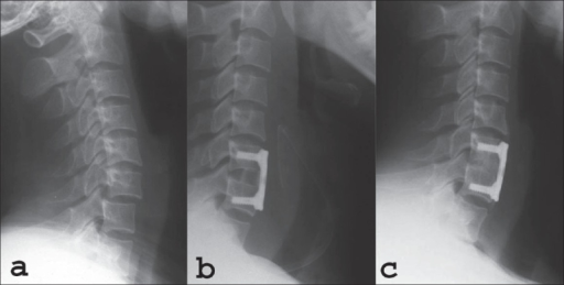 Dislocation of the Cervical Spine