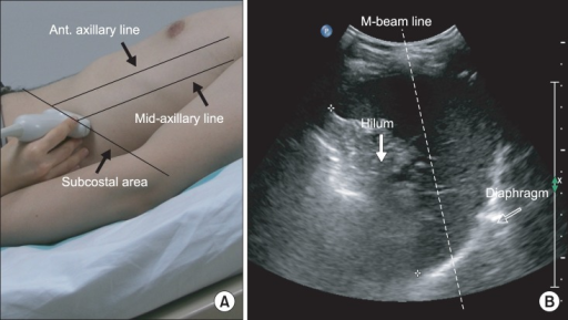 (A) Ultrasonographic approach to the left diaphragm. Th | Open-i