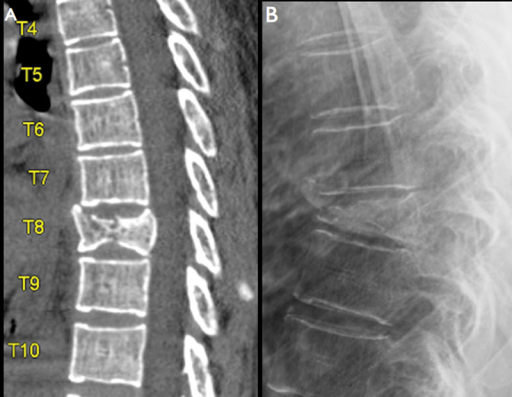 pathological fracture vertebra icd 10