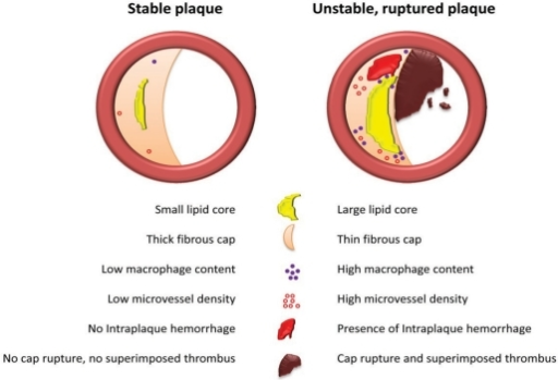 Stable Vs Unstable Plaque