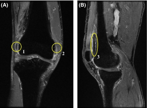 MRI findings. (A) The coronal and (B) sagittal T2-weighted (T2-STIR) MRI images of the right knee. These images reveal effusion of synovial fluid (circles 1 and 3), thickening of the inflamed synovium (circles 1–3) and mild degenerative bone changes (circles 1–3).