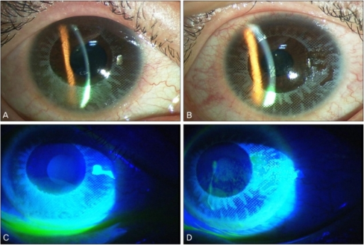 Slit-lamp photographs at the first examination (A,C, ri | Open-i