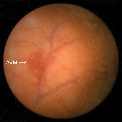 Video capsule endoscopy shows an AVM in the terminal il | Open-i