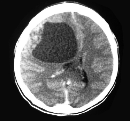 CT brain showing space occupying lesion in the right fr | Open-i