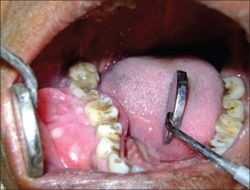 Clinical photograph showing the swelling in the mandibu