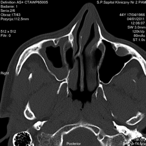 Axial CT scan – chronic maxillary sinusitis, polypus | Open-i