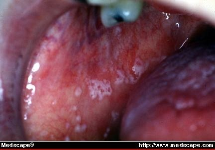 pseudomembranous candidiasis