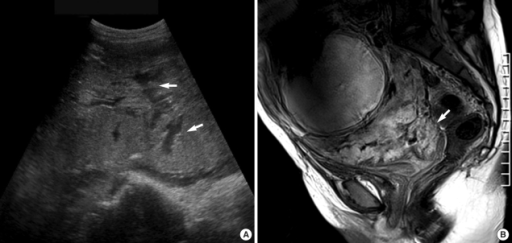 placenta posterioara gradul 2