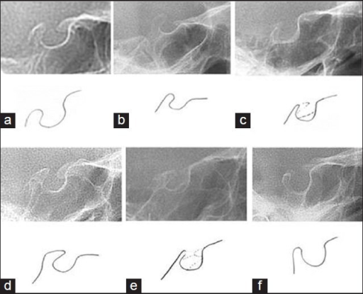 Different morphological types of sella turcica: (a) Nor | Open-i