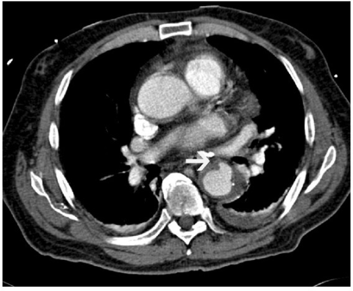 Penetrating atherosclerotic ulcer—axial postcontrast | Open-i