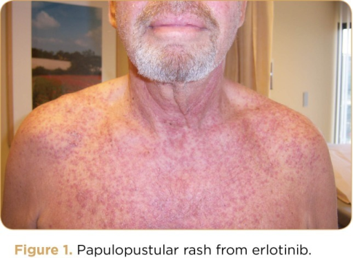 Figure 1. Papulopustular rash from erlotinib. | Open-i