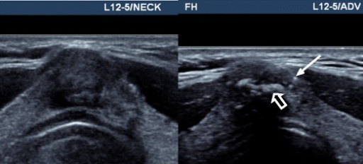 Transverse images of a 1-cm thyroid isthmus nodule usin | Open-i