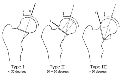 Pauwels' classification (Modified with permission from | Open-i