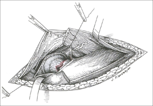 The Watson-Jones Anterolateral Exposure To The Hip For | Open-i