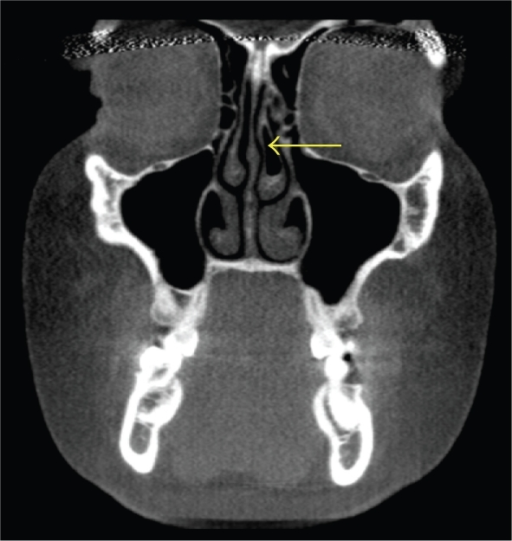 Coronal CT scan demonstrating the presence of left midd | Open-i