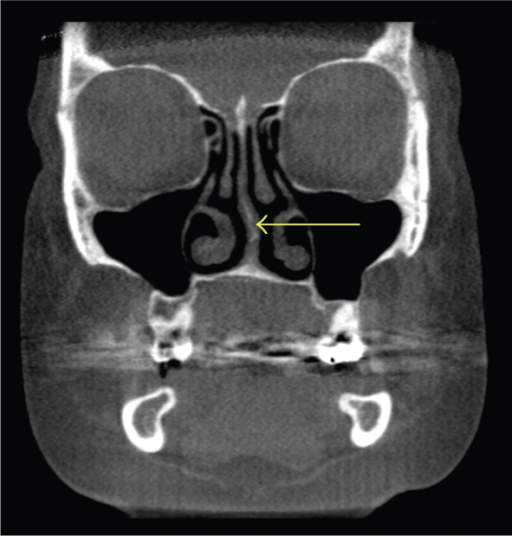 Coronal CT scan demonstrating left nasal septal deviati | Open-i