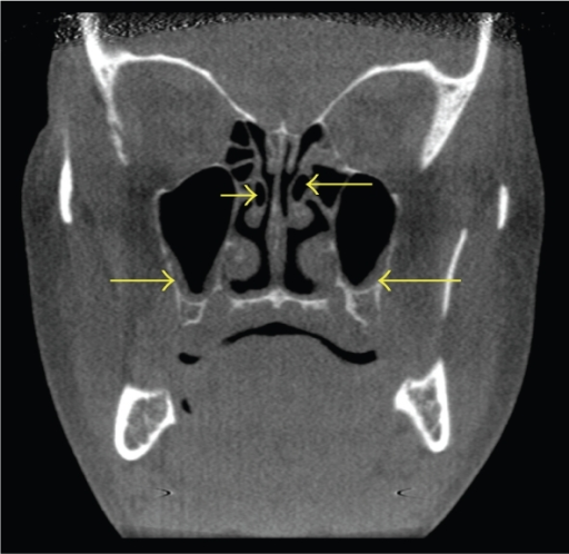 Coronal CT scan demonstrating bilateral middle concha b | Open-i