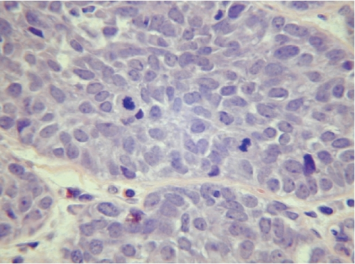 Recurrent sialoblastoma, which forms nests of pleomorph | Open-i