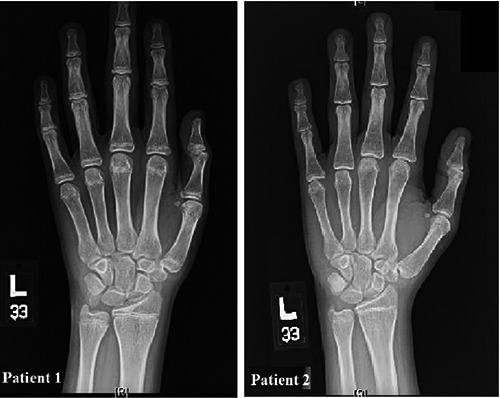 Hand X-ray showed delayed bone growth. Patient 1: The c | Open-i