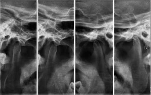 Transcranial Projection Of Both Temporomandibular Joint Open I