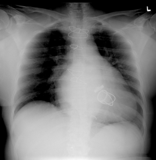 CXR showing cardiomegaly with ball in cage mechanical p | Open-i