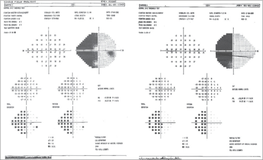 Visual field revealing left homonymous hemianopia | Open-i