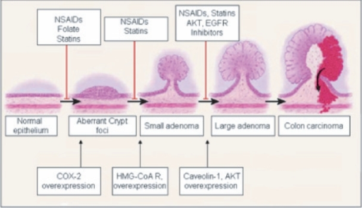 Colon cancer progression and overexpression of stage sp | Open-i