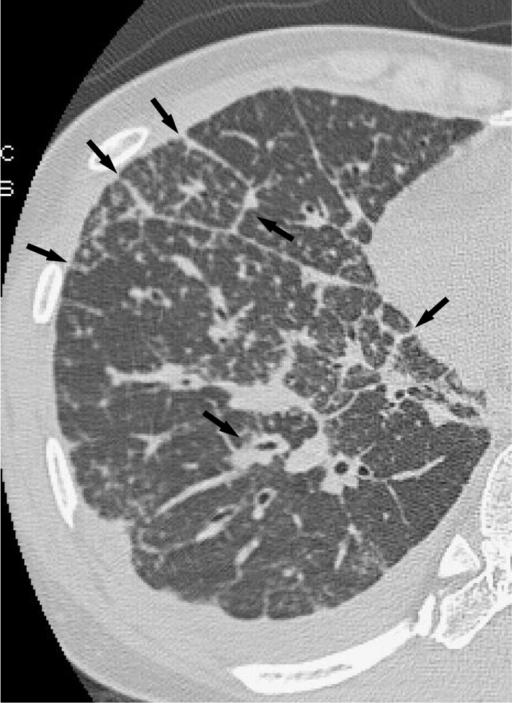 Imaging Findings For Interstitial Thickening In Sarcoid Open I