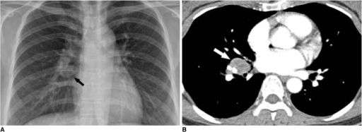 imaging-findings-for-unilateral-hilar-lymphadenopathy-i-open-i