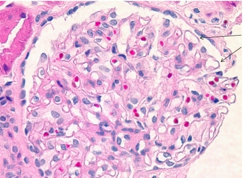 Primary membranous nephropathy (MN) (hematoxylin and eo | Open-i