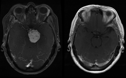 An axial gadolinium-enhanced contrasted T1-weighted MRI | Open-i