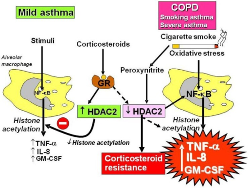 Mechanism of corticosteroid resistance in COPD, smoking asthma and severe asthma. Stimulation of mild asthmatic alveolar macrophages activates nuclear factor-κB (NF-κB) and other transcription factors to switch on histone acetyltransferase leading to histone acetylation and subsequently to transcription of genes encoding inflammatory proteins, such as tumour necrosis factor-α (TNF-α), interleukin-8 (IL-8) and granulocyte-macrophage colony stimulating factor (GM-CSF). Corticosteroids reverse this by binding to glucocorticoid receptors (GR) and recruiting histone deacetylase-2 (HDAC2). This reverses the histone acetylation induced by NF-κB and switches off the activated inflammatory genes. In COPD patients and smoking asthmatics cigarette smoke generates oxidative stress (acting through the formation of peroxynitrite) and in severe asthma and COPD intense inflammation generates oxidative stress to impair the activity of HDAC2. This amplifies the inflammatory response to NF-κB activation, but also reduces the anti-inflammatory effect of corticosteroids, as HDAC2 is now unable to reverse histone acetylation.