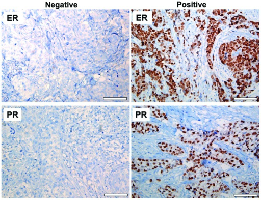 Immunohistochemical analysis of estrogen receptor (ER