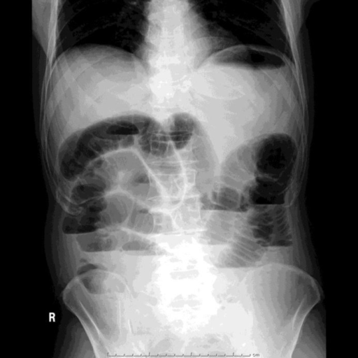 Upright abdominal X-ray of case 2, a male 64-year-old J | Open-i