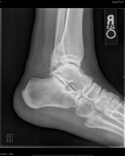 Lateral ankle demonstrates minimally-displaced fracture of posterior ...