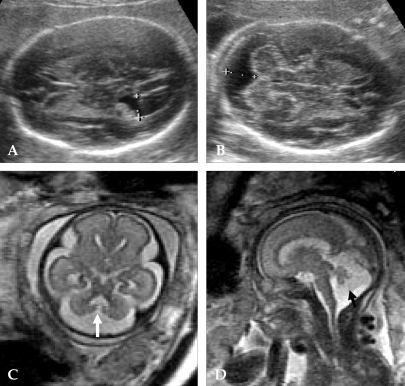 A case diagnosed as suspicious of Dandy-Walker variant | Open-i