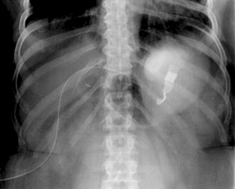 ray pad retained abdominal laparotomy drain penrose fig3 left film quadrant upper open radiologist mistakenly present read